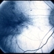 Choroideremia